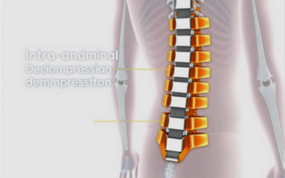 Will A Back Brace Help With Lower Back Pain?