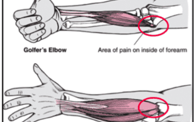 What Is The Best Brace For Elbow Tendonitis