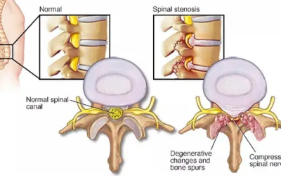 What Is The Best Back Brace For Spinal Stenosis