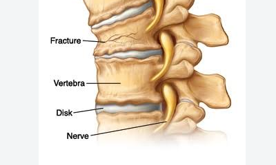 What Kind Of Back Brace For Compression Fracture is the Best