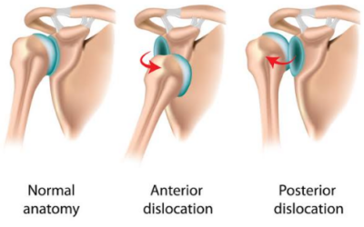 Are Slings For Shoulder Dislocation Worth It