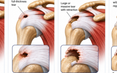 5 Best Slings For Rotator Cuff Surgery: Backed By Experts