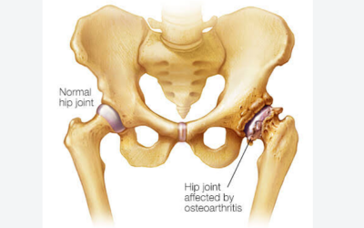 Do Hip Braces Help With Hip Arthritis