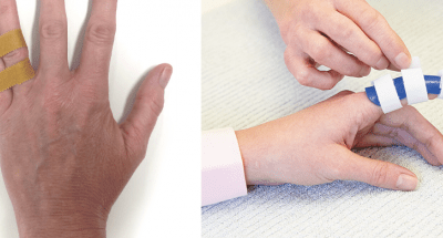 Buddy Tape Vs Finger Splint: Which To Choose